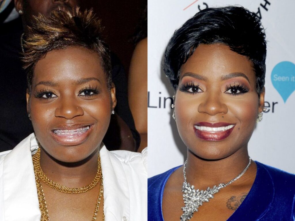 Fantasia Barrino Plastic Surgery