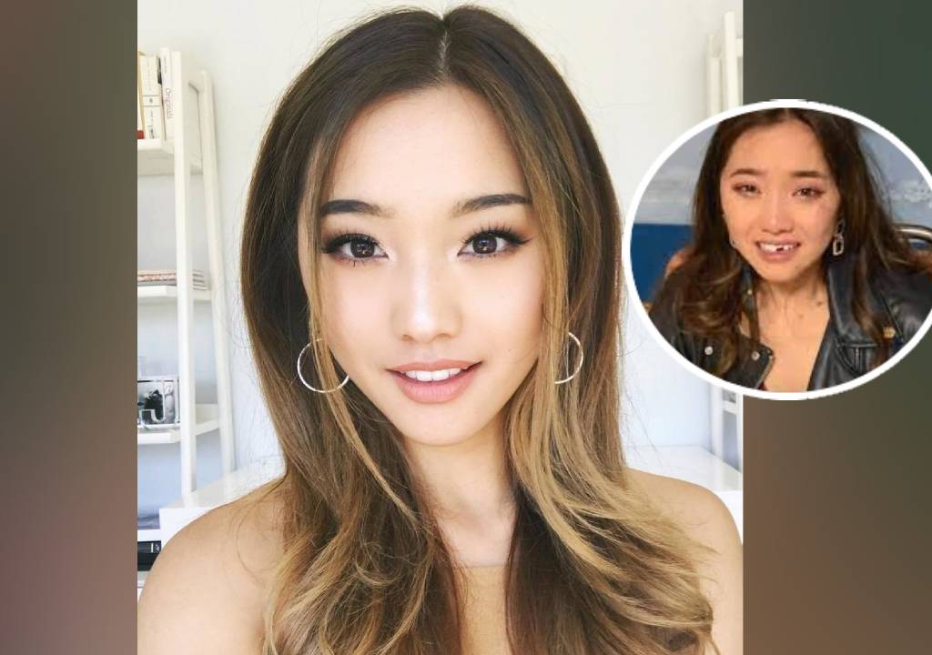 Jenn Im Teeth Accident